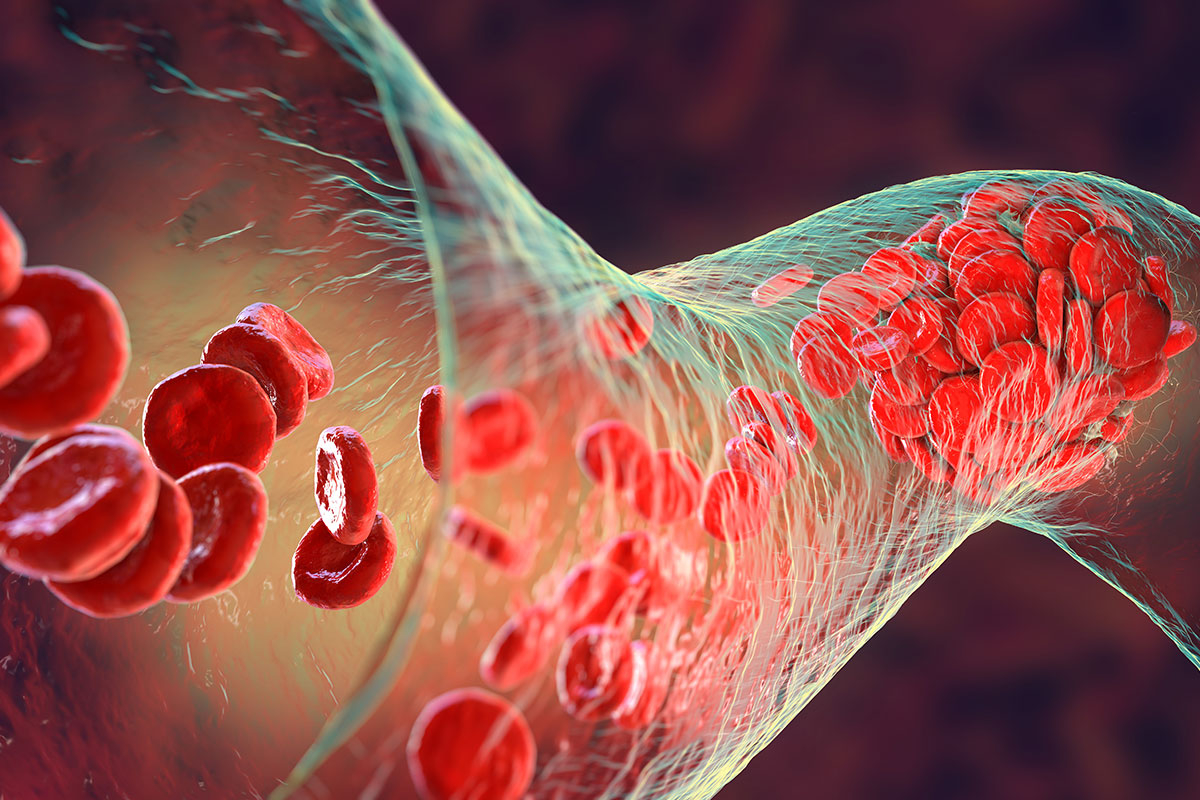 High Cholesterol: Understand the Causes, Symptoms, Diagnosis, and Treatment