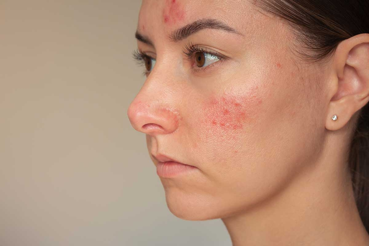 Rosacea: Causes, Symptoms, and Effective Treatments