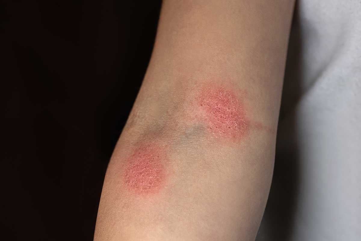 Fungal Infections (Mycosis): Causes, Types, Symptoms, and Treatments